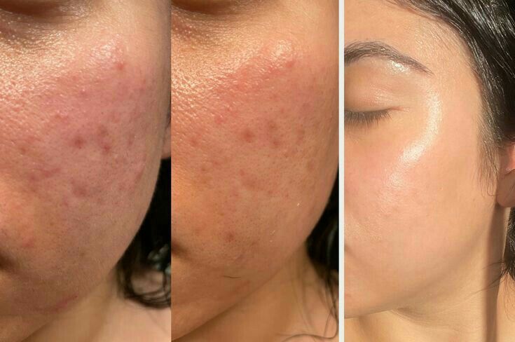 Before and after comparison of skin treatment on a person's face.