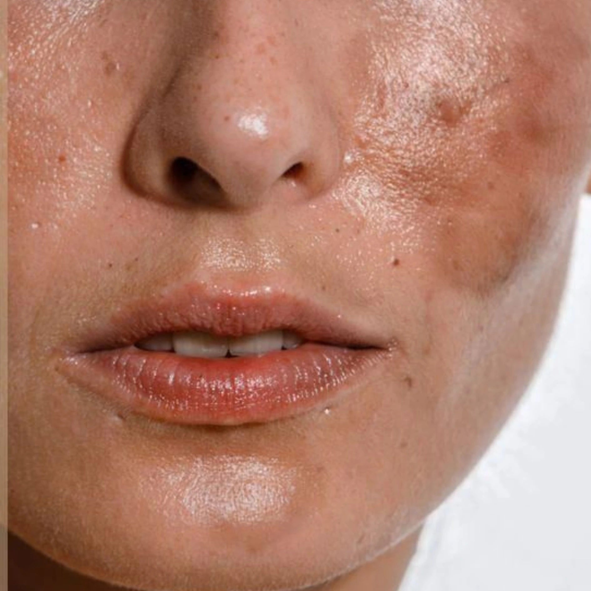 Blemish Freckles Care